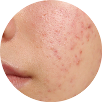 Yağlı Cilt - Sebum Dengesizligi