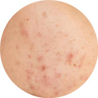 Akne ve Sivilce İzleri